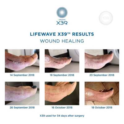 Lifewave X39 Stemcell patches-drug free nanotechnology